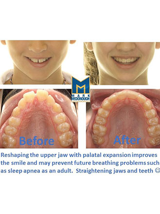 What Does a Palatal Expander Do?